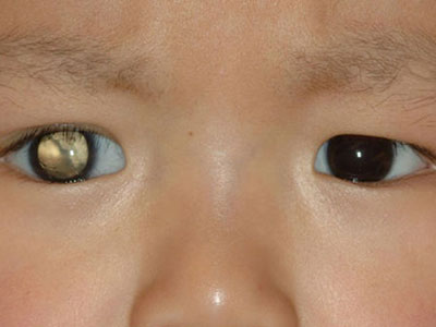 瞳孔發白是一種什麼病？