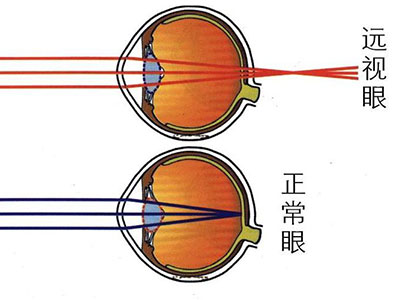 患有遠視是件“好事”嗎？