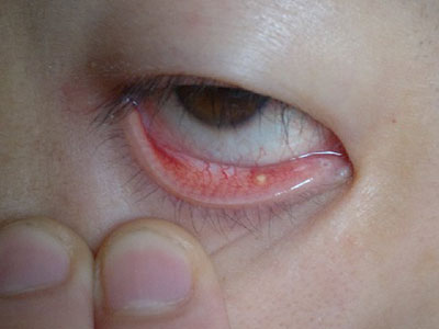 孩子眼睑上的小腫物很危險
