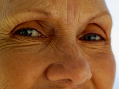 老年性眼睑下垂可手術治療