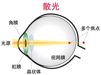 有散光請盡快進行治療