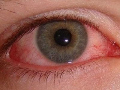 葡萄膜炎——可致盲的“紅眼病”