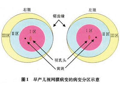 早產兒視網膜病變使孩子失去光明