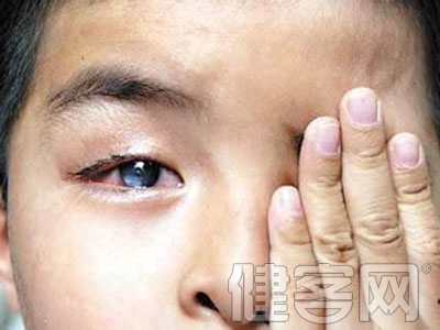 如何鑒別紅眼病和葡萄膜炎