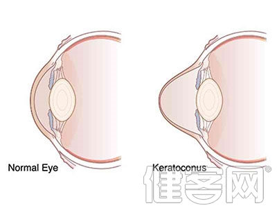 圓錐角膜的症狀和治療方法