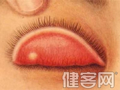 患麥粒腫要及早熱敷 亂捏小心病毒擠進腦