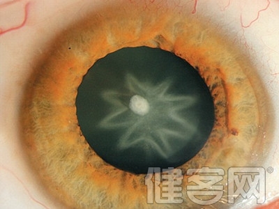 眼科知識：眼睛充血的病因症狀