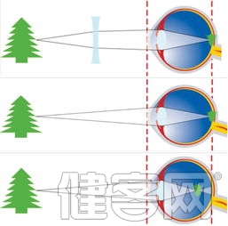 【視光】雙眼視異常的矯治原則