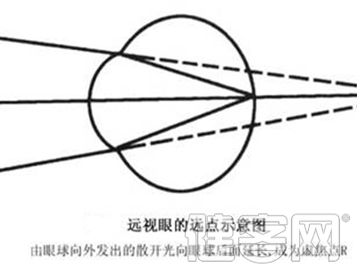 怎麼區分老花眼與遠視眼