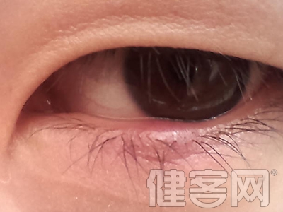 麥粒腫初期怎麼治療?