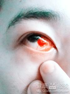 眼底中藥治療會導致出血嗎