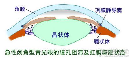 青光眼主要有哪些早期症狀