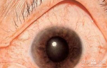 青光眼的鑒別診斷方法