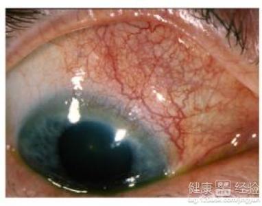 紅眼症的常見病因和症狀有哪些？