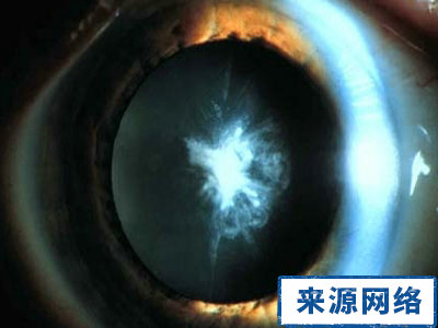 前極白內障 後極白內障 繞核性白內障 全白內障