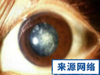 白內障