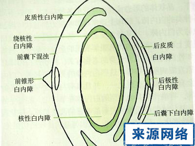 白內障 老花眼 治療 老年性白內障 視力模糊 晶狀體渾濁