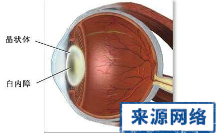 眼病 白內障 白內障手術 白內障藥物 眼睛 視力