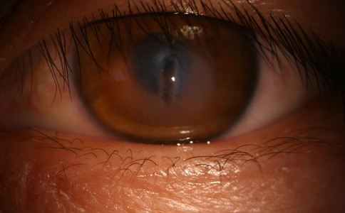 青光眼的症狀及治療 青光眼症狀及治療 青光眼注意事項