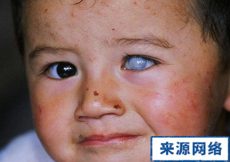 青光眼的症狀 青光眼的早期症狀 青光眼的治療方法