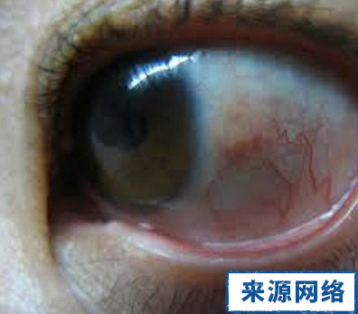 青光眼的症狀 青光眼的早期症狀 青光眼有什麼症狀