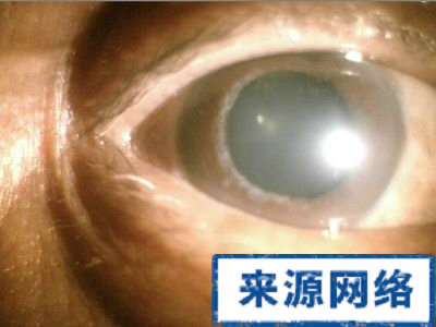 青光眼 危害 發病原因 診斷 風險 因素