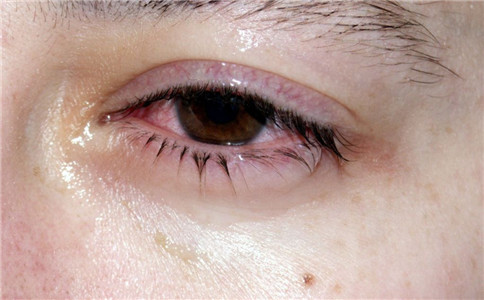 沙眼有什麼並發症 沙眼怎麼治療好 沙眼怎麼傳染