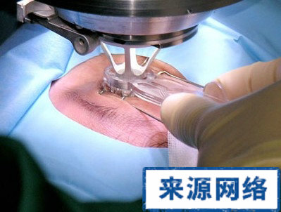 近視眼手術 激光手術 近視 近視准分子激光手術