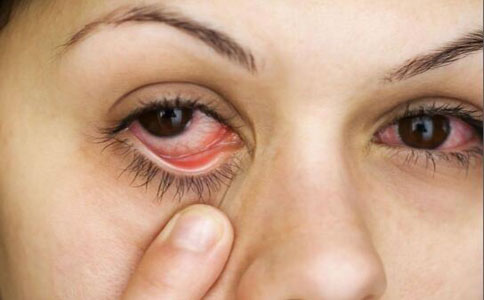 眼睛有血絲怎麼辦 眼睛紅血絲怎麼消除 如何消除眼睛血絲