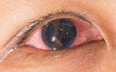 紅眼病有哪些症狀 紅眼病的症狀是什麼 紅眼病吃什麼好