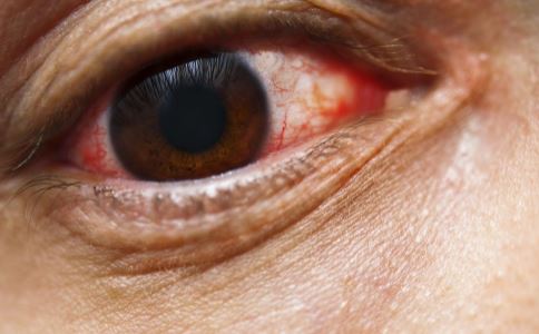紅眼病有哪些症狀 紅眼病的症狀是什麼 紅眼病吃什麼好
