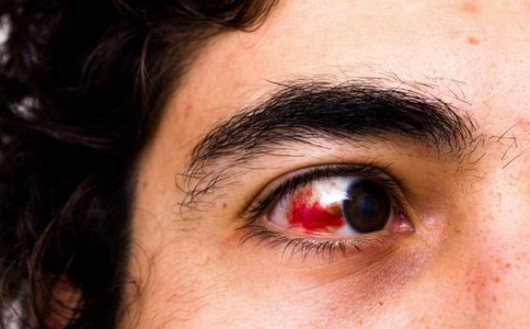 紅眼病有哪些症狀 紅眼病如何檢查 紅眼病的症狀有哪些