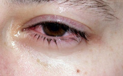 什麼是紅眼病 怎麼治療紅眼病 如何治療紅眼病