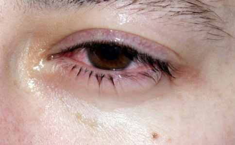 紅眼病的症狀 紅眼病的治療方法 如何預防紅眼病傳染