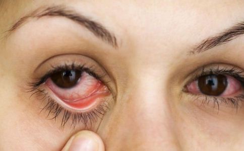 紅眼病怎麼治療 紅眼病的治療方法有哪些 紅眼病怎麼護理