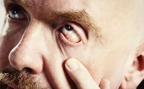紅眼病的症狀有哪些 紅眼病會傳染嗎 紅眼病有什麼危害
