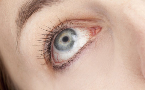 治療紅眼病的偏方有哪些 如何治療紅眼病 紅眼病怎麼辦
