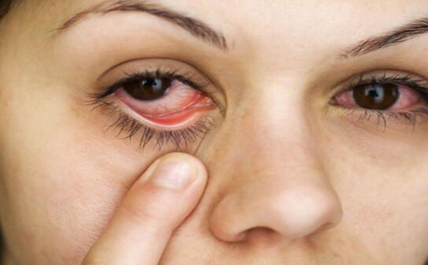 如何預防紅眼病 預防紅眼病的措施有哪些 預防紅眼病怎麼做