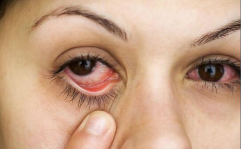 什麼是紅眼病 如何治療紅眼病 如何預防紅眼病