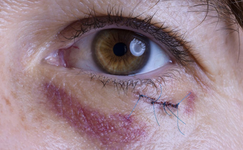 眼部受傷有哪些症狀 眼部受傷如何處理 眼部受傷會帶來哪些影響
