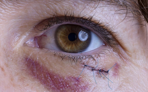 導致眼外傷的原因 眼外傷的原因有哪些 眼睛受傷有哪些原因