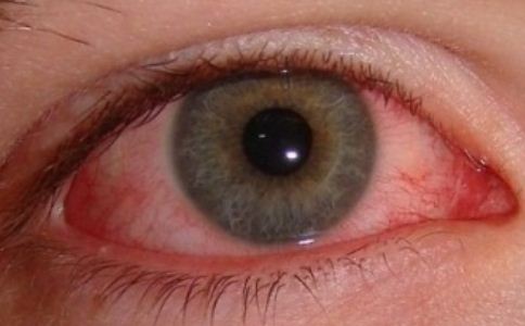 紅眼病 紅眼病的護理方法 治療紅眼病的土方法	