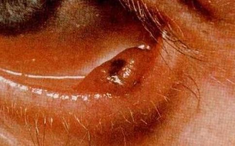 眼睑帶狀疱疹 眼睑疱疹 眼睑單純疱疹