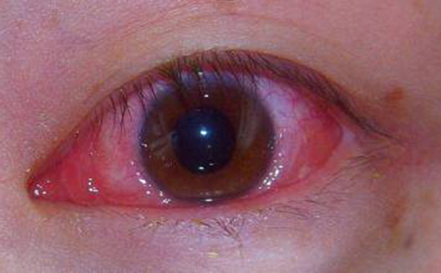 紅眼病的症狀有哪些 紅眼病的治療方法是什麼 紅眼病如何治療