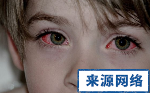 紅眼病怎麼護理 紅眼病護理措施 紅眼病護理方法