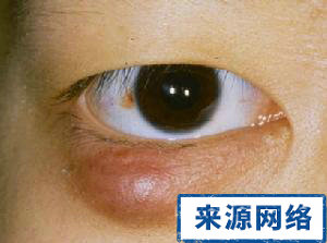 麥粒腫怎麼治療 麥粒腫症狀 為什麼會長針眼