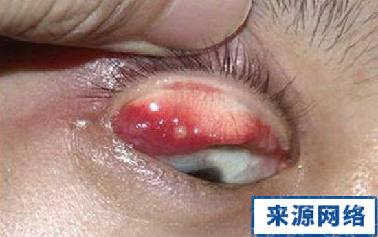 內麥粒腫症狀圖 麥粒腫圖片 內麥粒腫