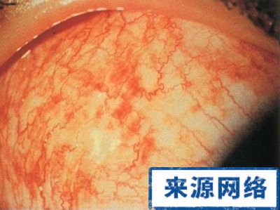 症狀診斷 眼睛發紅 紅眼病 疾病 角膜炎 發炎